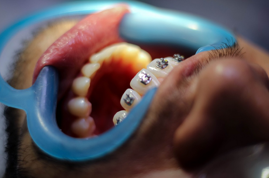 braces